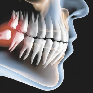 É realmente necessário extrair o dente siso?